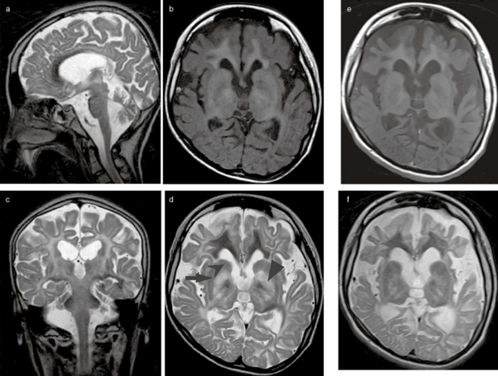 Diagnosis and Treatment of Canavan Diseas